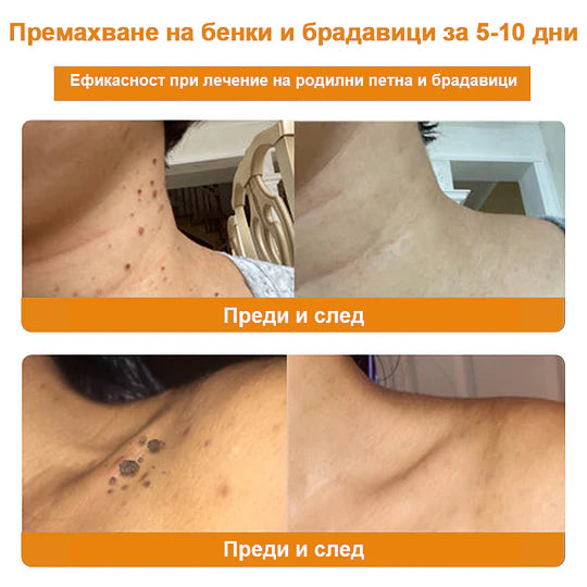 🔥Vsoxa™ Крем за премахване на брадавици и къртици с пчелна отрова (продажба в последния ден, 80% отстъпка)