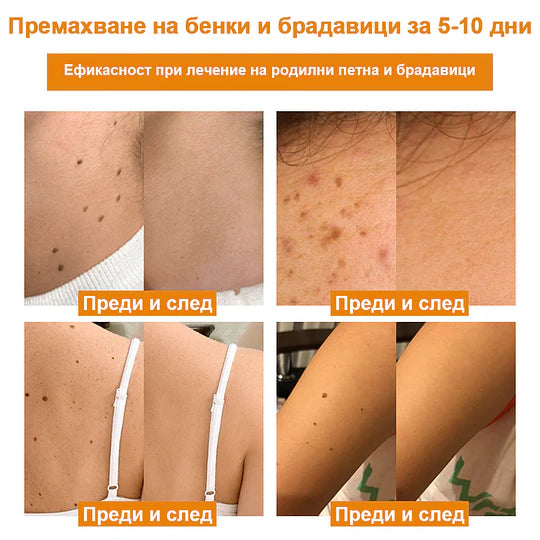 🔥Vsoxa™ Крем за премахване на брадавици и къртици с пчелна отрова (продажба в последния ден, 80% отстъпка)