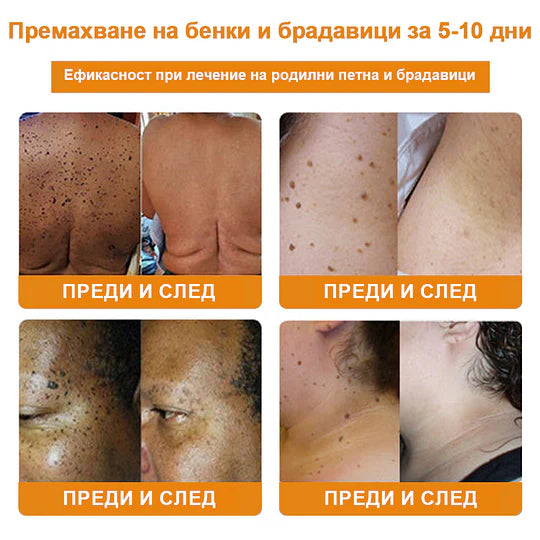 🔥Vsoxa™ Крем за премахване на брадавици и къртици с пчелна отрова (продажба в последния ден, 80% отстъпка)