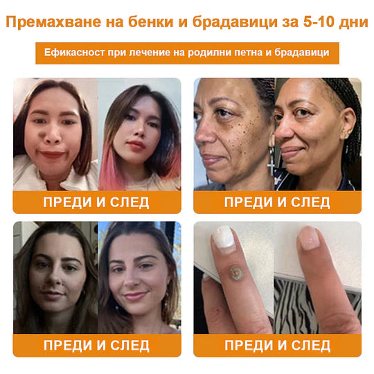 🔥Vsoxa™ Крем за премахване на брадавици и къртици с пчелна отрова (продажба в последния ден, 80% отстъпка)