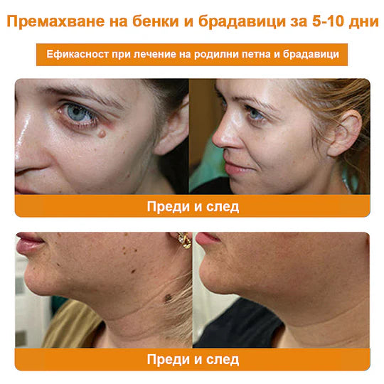 🔥Vsoxa™ Крем за премахване на брадавици и къртици с пчелна отрова (продажба в последния ден, 80% отстъпка)