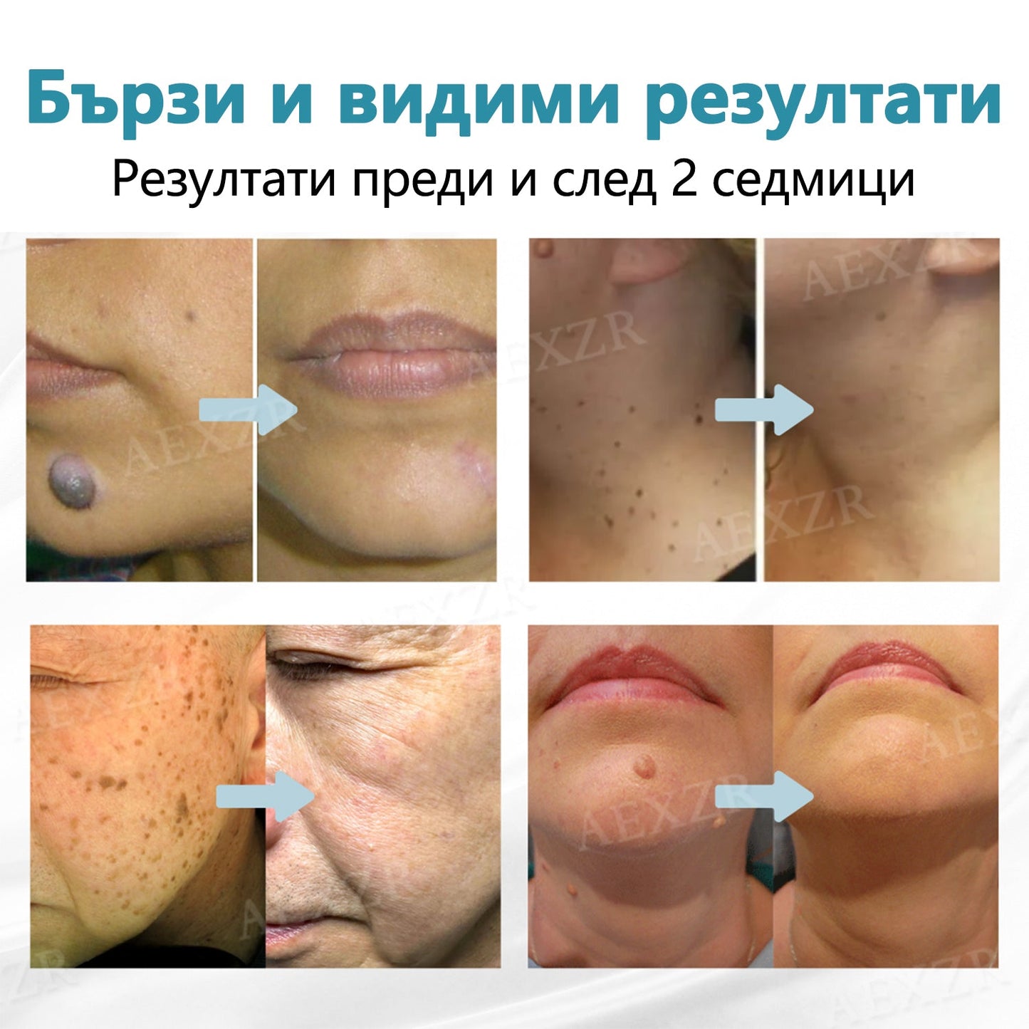 Bikenda® неинвазивна лазерна писалка за премахване на бенки и брадавици 🌟