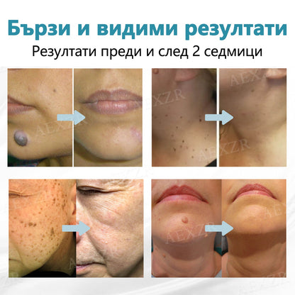 Bikenda® неинвазивна лазерна писалка за премахване на бенки и брадавици 🌟