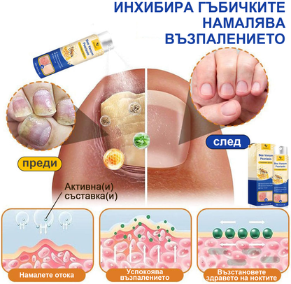 👨‍⚕Furzero™ Спрей за лечение на псориазис за намаляване на сърбежа и възпалението след 2 седмици. (Д-р Каройи Кристина: достоверна препоръка)