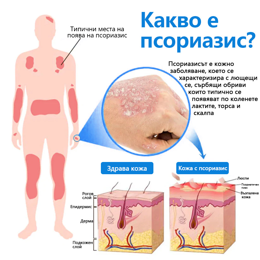 Официален магазин✨: Zvoevo® Магнезиев билков спрей за псориазис⚕️Сертифициран от FDA (облекчаване на псориазис и екзема, подобряване на бактериални инфекции в гениталната област и лечение на акне и тъмни петна)
