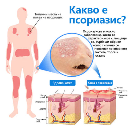 Официален магазин✨: Zvoevo® Магнезиев билков спрей за псориазис⚕️Сертифициран от FDA (облекчаване на псориазис и екзема, подобряване на бактериални инфекции в гениталната област и лечение на акне и тъмни петна)