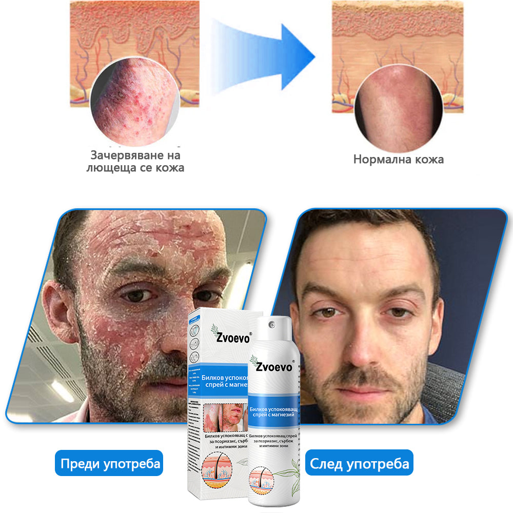 Официален магазин✨: Zvoevo® Магнезиев билков спрей за псориазис⚕️Сертифициран от FDA (облекчаване на псориазис и екзема, подобряване на бактериални инфекции в гениталната област и лечение на акне и тъмни петна)
