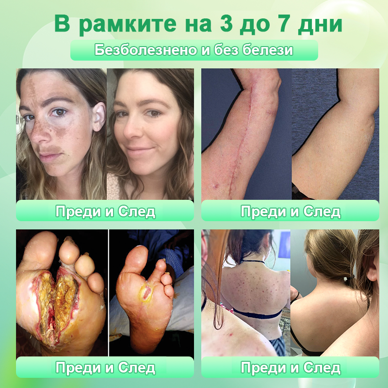 🍇Почистващ ексфолиращ гел за акантозис нигриканс, ексфолиация, тъмни петна, кожни етикети и екзема