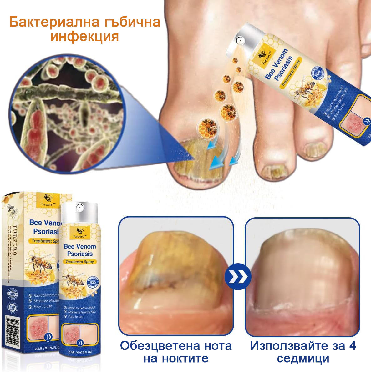 👨‍⚕Furzero™ Спрей за лечение на псориазис за намаляване на сърбежа и възпалението след 2 седмици. (Д-р Каройи Кристина: достоверна препоръка)