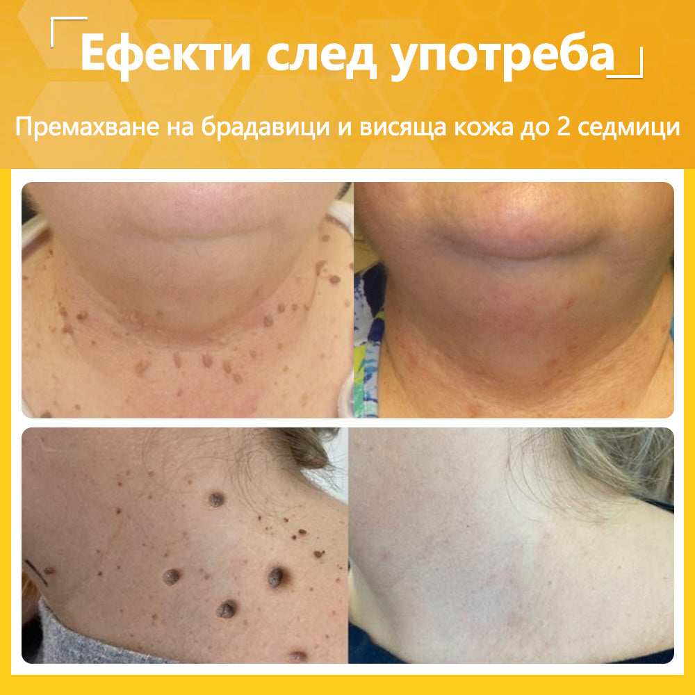 ✅flysmus® Силен крем с пчелен отров – ✨Препоръчван от експерти по дерматология. Ефективен срещу брадавици, издутини, лезии, инфекции и белези.🐝