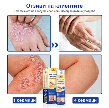 👨‍⚕Furzero™ Спрей за лечение на псориазис за намаляване на сърбежа и възпалението след 2 седмици. (Д-р Каройи Кристина: достоверна препоръка)