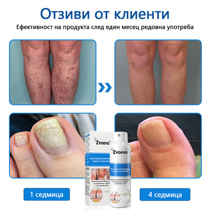 Официален магазин✨: Zvoevo® Магнезиев билков спрей за псориазис⚕️Сертифициран от FDA (облекчаване на псориазис и екзема, подобряване на бактериални инфекции в гениталната област и лечение на акне и тъмни петна)