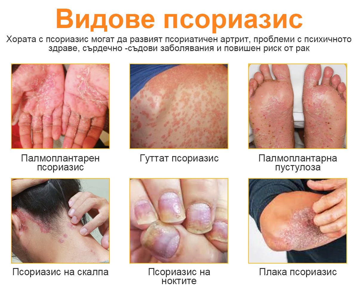 👨‍⚕Furzero™ Спрей за лечение на псориазис за намаляване на сърбежа и възпалението след 2 седмици. (Д-р Каройи Кристина: достоверна препоръка)