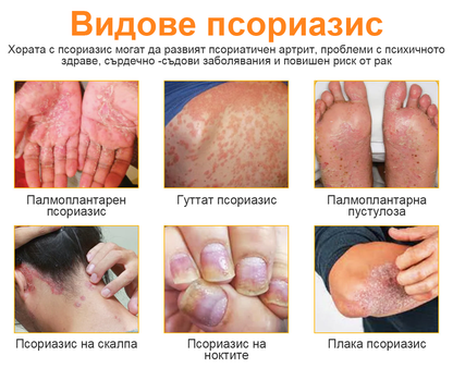 👨‍⚕Furzero™ Спрей за лечение на псориазис за намаляване на сърбежа и възпалението след 2 седмици. (Д-р Каройи Кристина: достоверна препоръка)