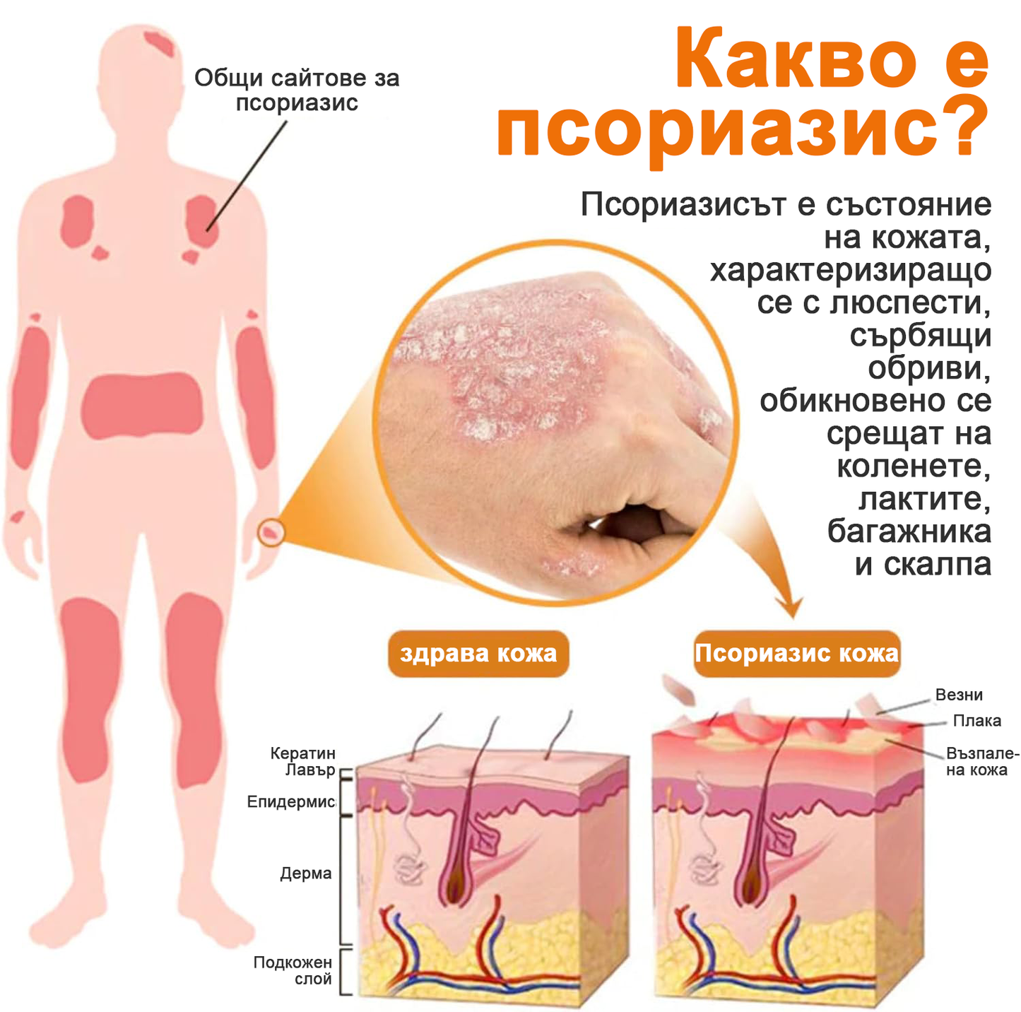 👨‍⚕Furzero™ Спрей за лечение на псориазис за намаляване на сърбежа и възпалението след 2 седмици. (Д-р Каройи Кристина: достоверна препоръка)
