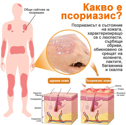 👨‍⚕Furzero™ Спрей за лечение на псориазис за намаляване на сърбежа и възпалението след 2 седмици. (Д-р Каройи Кристина: достоверна препоръка)