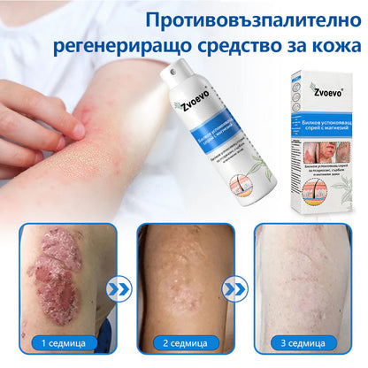Официален магазин✨: Zvoevo® Магнезиев билков спрей за псориазис⚕️Сертифициран от FDA (облекчаване на псориазис и екзема, подобряване на бактериални инфекции в гениталната област и лечение на акне и тъмни петна)