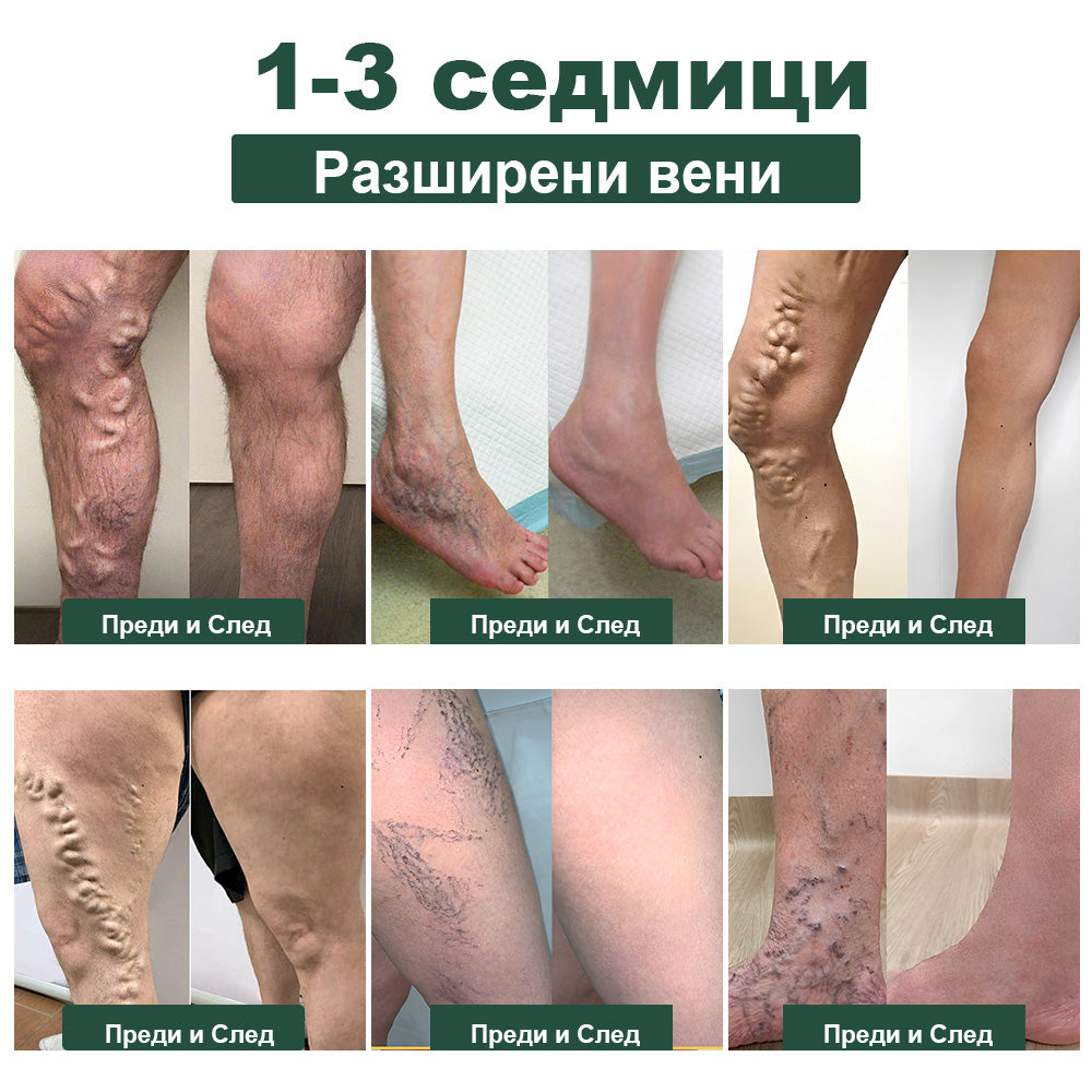 𝐁𝐞𝐧𝐞𝐭𝐮𝐫𝐞™ пчелна отрова за отслабване лимфен детоксикиращ крак топки 🫚-- Препоръчано от клиника Мейо